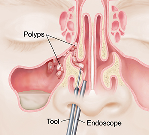 What is sinus surgery?