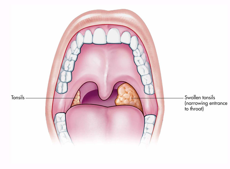 Tonsil Treatment in Kothrud